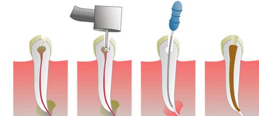 dentiron461.jpg